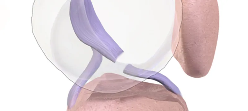 Illustration of a torn anterior cruciate ligament in the knee