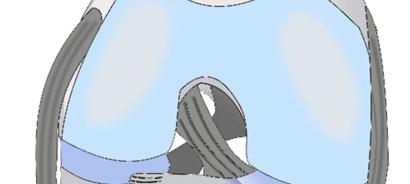 Illustration of the front of the knee with the joint cartilage highlighted