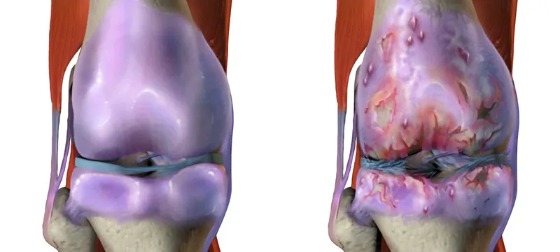Illustration comparing a healthy knee with a knee affected by osteoarthritis