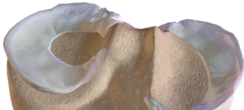 Illustration of the two menisci resting on the top of the shin bone