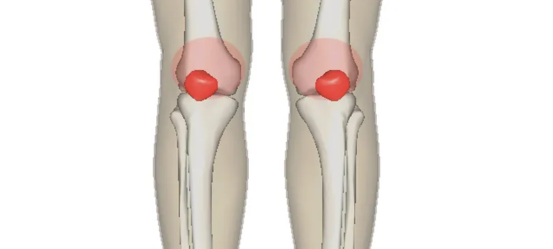 Illustration of both legs with the kneecaps highlighted